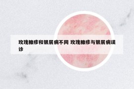 玫瑰糠疹和銀屑病不同 玫瑰糠疹與銀屑病誤診