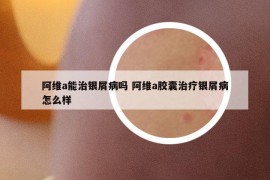 阿維a能治銀屑病嗎 阿維a膠囊治療銀屑病怎么樣