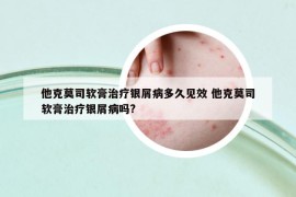 他克莫司軟膏治療銀屑病多久見效 他克莫司軟膏治療銀屑病嗎?