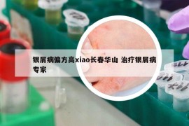 銀屑病偏方高xiao長春華山 治療銀屑病專家