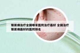 銀屑病治療全國哪家醫(yī)院治療最好 全國治療銀屑病最好的醫(yī)院排名