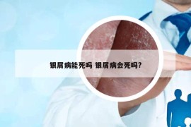 銀屑病能死嗎 銀屑病會死嗎?