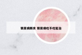 銀屑病斷食 銀屑病吃不吃能治