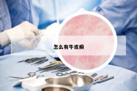 怎么有牛皮癬