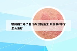 銀屑病三年了有什辦法能治玉 銀屑病6年了怎么治療