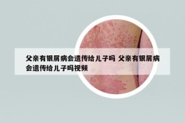 父親有銀屑病會遺傳給兒子嗎 父親有銀屑病會遺傳給兒子嗎視頻