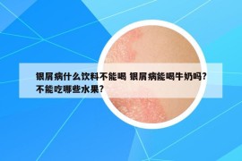 銀屑病什么飲料不能喝 銀屑病能喝牛奶嗎?不能吃哪些水果?