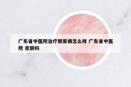 廣東省中醫(yī)院治療銀屑病怎么樣 廣東省中醫(yī)院 皮膚科
