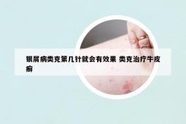 銀屑病類克第幾針就會有效果 類克治療牛皮癬