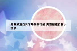 男生尿道口長了牛皮癬樣的 男性尿道口有小疹子
