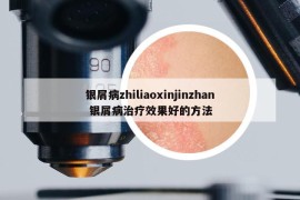 銀屑病zhiliaoxinjinzhan 銀屑病治療效果好的方法