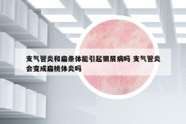 支氣管炎和扁條體能引起銀屑病嗎 支氣管炎會(huì)變成扁桃體炎嗎