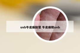 uvb牛皮癬耐受 牛皮癬照uvb