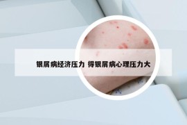 銀屑病經(jīng)濟壓力 得銀屑病心理壓力大