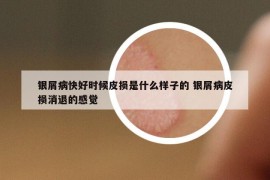 銀屑病快好時候皮損是什么樣子的 銀屑病皮損消退的感覺