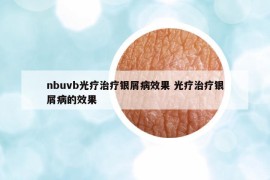 nbuvb光療治療銀屑病效果 光療治療銀屑病的效果