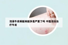 泡澡牛皮癬越來越多是嚴重了嗎 中醫(yī)泡浴治療牛皮