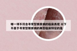 哪一項不符合尋常型銀屑病的臨床表現(xiàn) 以下不屬于尋常型銀屑病的典型臨床特征的是