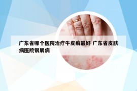 廣東省哪個(gè)醫(yī)院治療牛皮癬最好 廣東省皮膚病醫(yī)院銀屑病