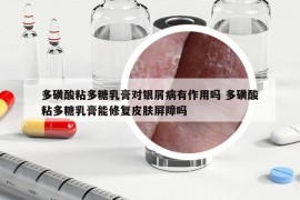 多磺酸粘多糖乳膏對銀屑病有作用嗎 多磺酸粘多糖乳膏能修復(fù)皮膚屏障嗎