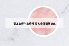 嬰兒會得牛皮癬嗎 嬰兒會得銀屑病么