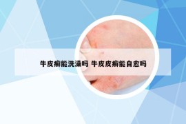 牛皮癬能洗澡嗎 牛皮皮癬能自愈嗎