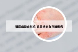 銀屑病能自慰嗎 銀屑病能自己消退嗎