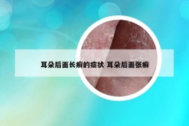 耳朵后面長癬的癥狀 耳朵后面張癬