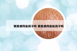 銀屑病傳染孩子嗎 銀屑病傳染給孩子嗎
