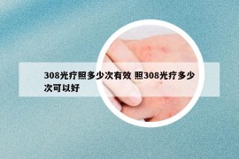 308光療照多少次有效 照308光療多少次可以好