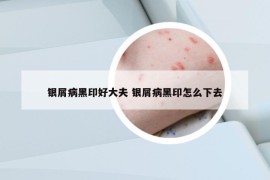 銀屑病黑印好大夫 銀屑病黑印怎么下去