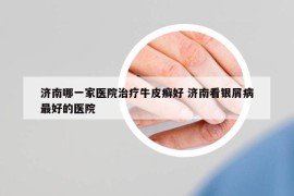 濟(jì)南哪一家醫(yī)院治療牛皮癬好 濟(jì)南看銀屑病最好的醫(yī)院