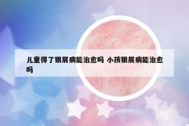 兒童得了銀屑病能治愈嗎 小孩銀屑病能治愈嗎