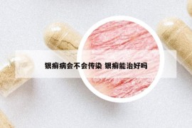 銀癬病會不會傳染 銀癬能治好嗎