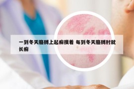 一到冬天胳膊上起癬摸著 每到冬天胳膊肘就長癬