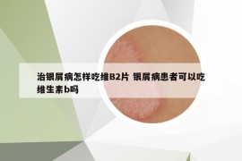 治銀屑病怎樣吃維B2片 銀屑病患者可以吃維生素b嗎