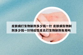 皮膚病打生物制劑多少錢(qián)一針 皮膚病生物制劑多少錢(qián)一針特應(yīng)性皮炎打生物制劑有用嗎