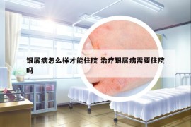 銀屑病怎么樣才能住院 治療銀屑病需要住院嗎