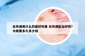 白風(fēng)病用什么藥最好效果 白風(fēng)病能治好嗎?大概要多久多少錢