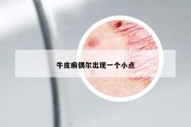 牛皮癬偶爾出現(xiàn)一個(gè)小點(diǎn)