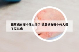 銀屑病有哪個偉人得了 銀屑病有哪個偉人得了艾滋病