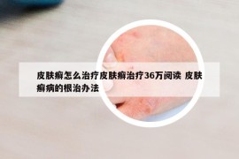 皮膚癬怎么治療皮膚癬治療36萬閱讀 皮膚癬病的根治辦法