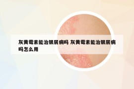 灰黃霉素能治銀屑病嗎 灰黃霉素能治銀屑病嗎怎么用