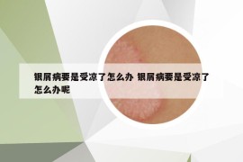 銀屑病要是受涼了怎么辦 銀屑病要是受涼了怎么辦呢