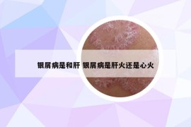 銀屑病是和肝 銀屑病是肝火還是心火