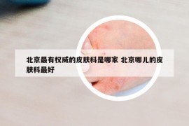 北京最有權(quán)威的皮膚科是哪家 北京哪兒的皮膚科最好