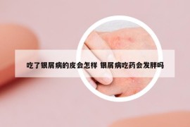 吃了銀屑病的皮會(huì)怎樣 銀屑病吃藥會(huì)發(fā)胖嗎