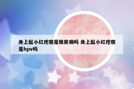 身上起小紅疙瘩是銀屑病嗎 身上起小紅疙瘩是hpv嗎
