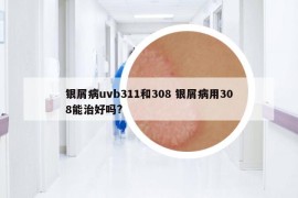 銀屑病uvb311和308 銀屑病用308能治好嗎?