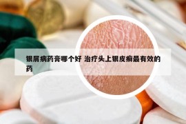 銀屑病藥膏哪個(gè)好 治療頭上銀皮癬最有效的藥